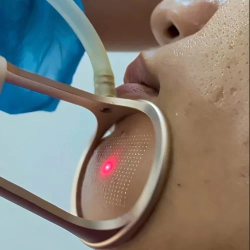 Practitioner performing a laser skin treatment on a client's cheek